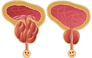 Comment Prostalix agit pour la prostatite avant et après le traitement