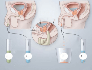Massage de la prostate