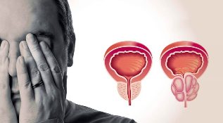 Prostate saine et enflammée