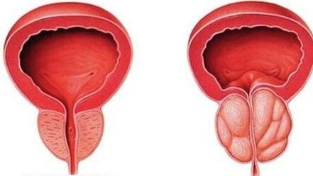 prostate normale et enflammée