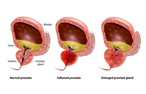 La prostatite est une inflammation de la prostate
