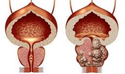 Saines et malsaines de la prostate