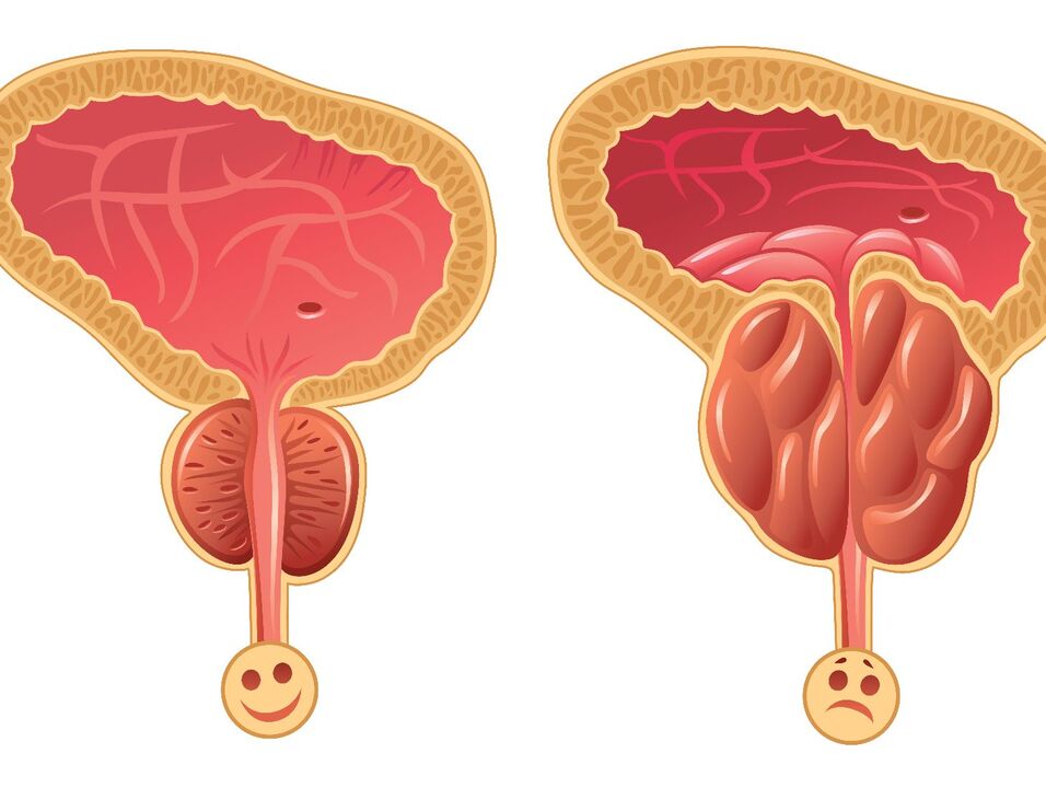Prostate saine et congestion de la prostate avec prostatite congestive